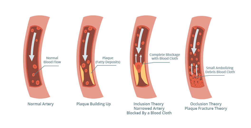 CAD Coronary Artery Disease
