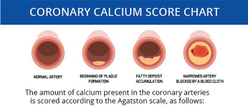 Calcium Score chart What Does A Calcium Score Test Show That Other Tests Do Not